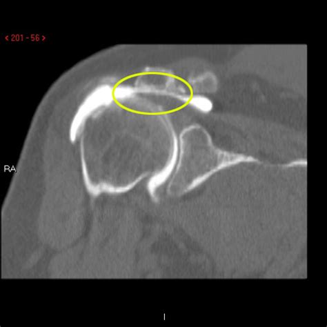 CT Arthrogram Shoulder: R/O Rotator Cuff or Labral Tear | Cedars-Sinai