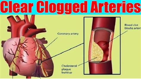 Remove Your Clogged Arteries And Control Blood Pressure | Best Ingredients to Clear Clogged ...