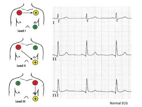 Figure 10: 3 lead ECG placement options - image from the HRW Project | Nursing mnemonics, Ekg ...