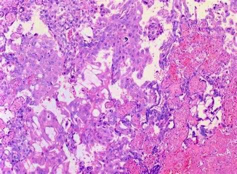 Choriocarcinoma Cytology