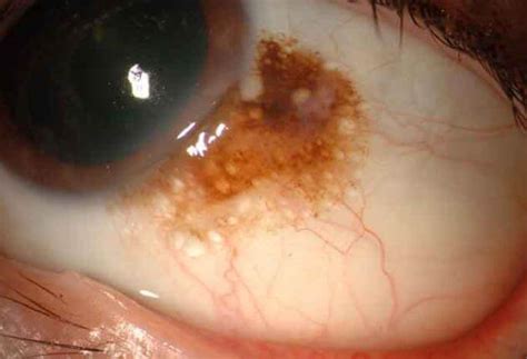 Conjunctival Nevus | Wills Eye Hospital