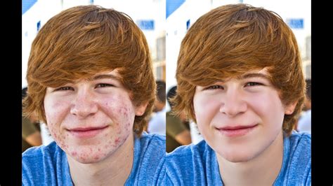 Photoshop tutorial : how to remove acne / pimple in photoshop - YouTube