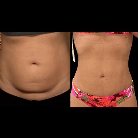 Tummy Tuck - Neinstein Plastic Surgery