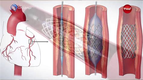 Cateterismo cardiaco - YouTube