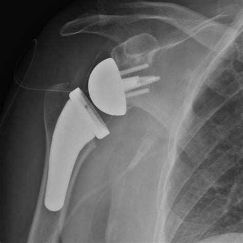 Reverse Total Shoulder Replacement | Dr Sunil Reddy