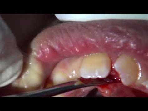 supernumerary tooth extraction - YouTube