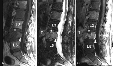 Burst Fracture | Radiology Key