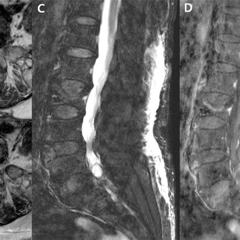 CT-myelogram of the lumbar spine showing a right intra-canalar,... | Download Scientific Diagram