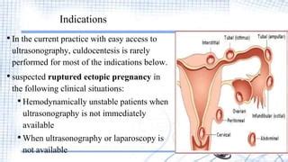 Culdocentesis | PPT