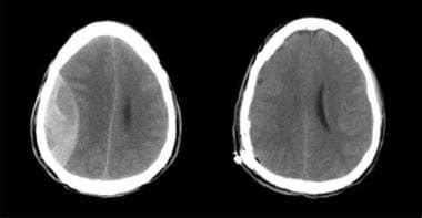 Epidural Hematoma Ct Findings