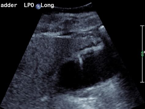 Adenomyomatosis Gallbladder