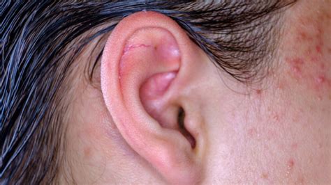 Causes And Treatment for Pimple in Ear: Know its Types And Home Remedies | PINKVILLA