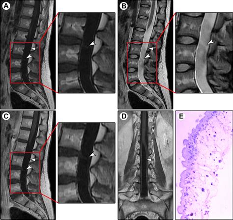 Spinal MRI and histopathology of Case 4. Spinal MRI showed a cystic ...