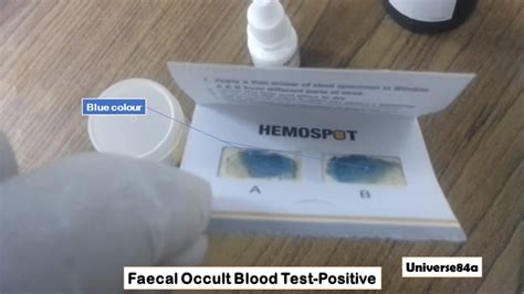 Faecal Occult Blood Test: Introduction, Principle, Procedure, Result Interp