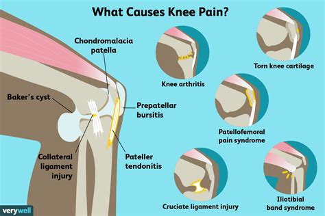 Knee Pain: Causes, Treatment, and When to See a Doctor