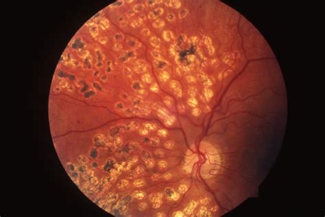 old laser burns on retina