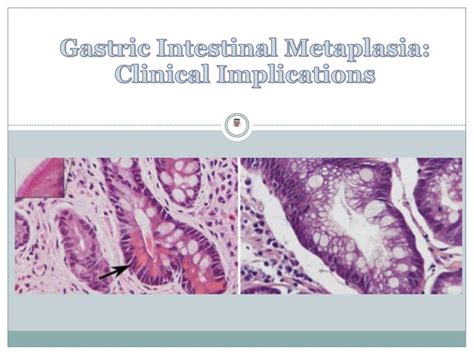 Gastric Intestinal Metaplasia - Clinical Implications