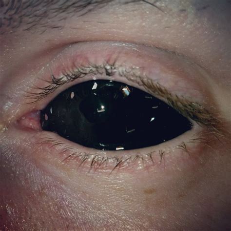 My new black metalflake prosthetic eye. : r/mildlyinteresting