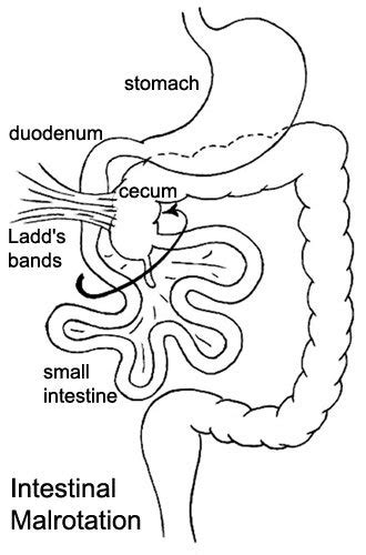 Intestinal malrotation treatment