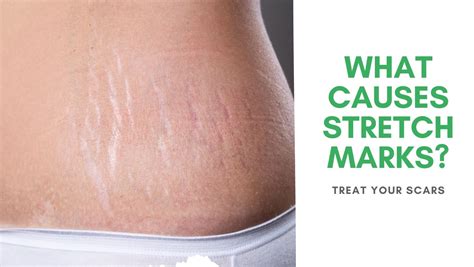 What Causes Stretch Marks? - Treat Your Scars