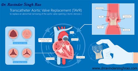 Transcatheter Mitral Valve Replacement (TMVR) expert in India