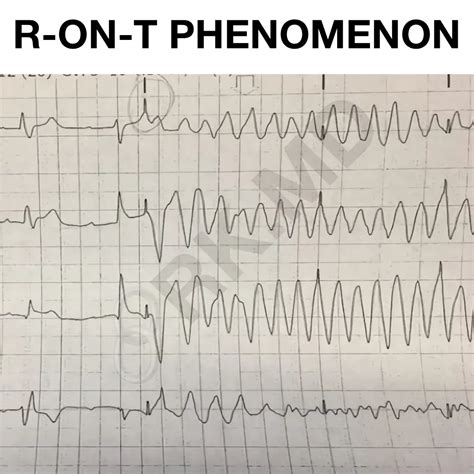 R-on-T Phenomenon | RK.MD