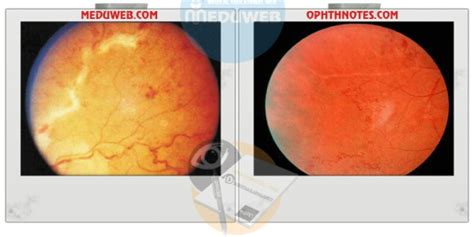 Eales disease - Meduweb