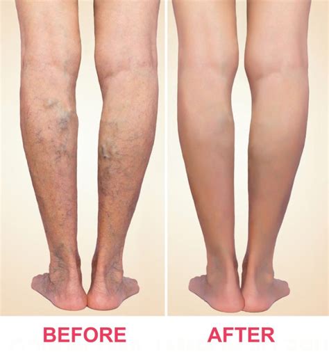 Varicose Veins Treatments | Fort Myers | Bonita Springs