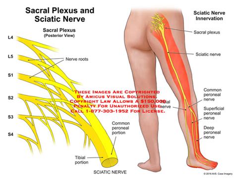 AMICUS Illustration of amicus,anatomy,sacral,plexus,sciatic,nerve,L4,L5,S1,S2,S3,S4,root,common ...