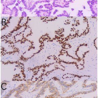 Pathological diagnosis of the right supraclavicular lymph node biopsy... | Download Scientific ...