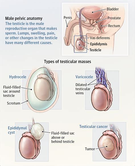 Testicular Mass | Oncology | JAMA | JAMA Network