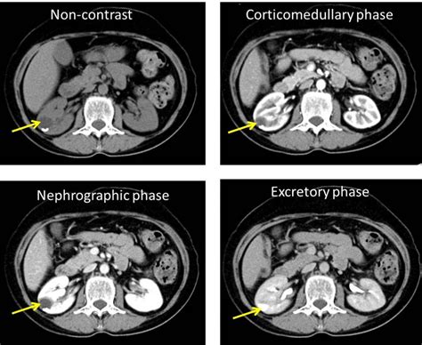 Calyceal diverticulum – Radiology Cases