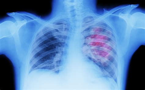 Mediastinal Lymphadenopathy