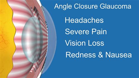 Acute Angle Glaucoma Symptoms