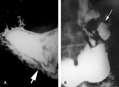 Lymphoma. (A) Barium meal examination shows thickening of rugal folds... | Download Scientific ...