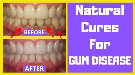 Gum Disease Treatment Home Remedy | Gum Disease Treatment At Home With NATURAL Remedies! - YouTube