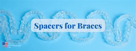 Spacers for Braces - Everything You Need To Know