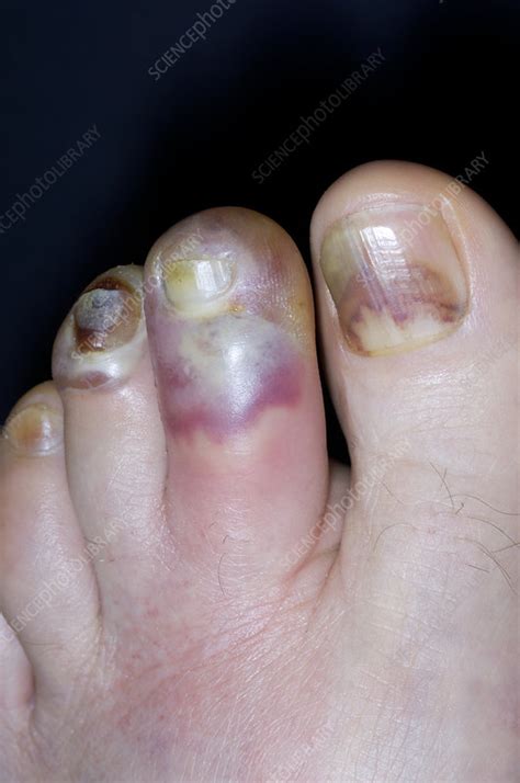 Cellulitis Toe