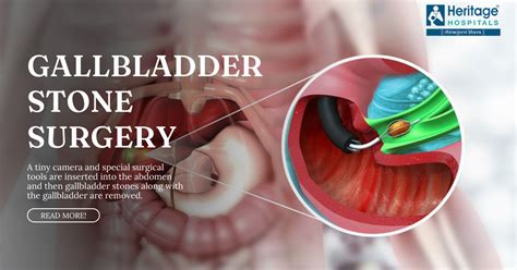 Gallbladder Stone Laparoscopic Surgery - Heritage Hospitals - Heritage ...