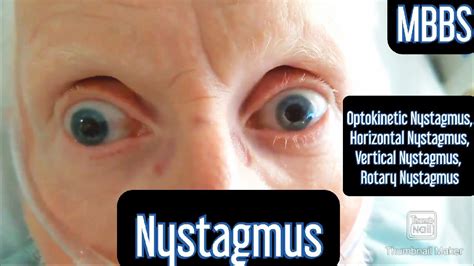 Nystagmus- Optokinetic, Horizontal, Vertical, Rotary #mbbs #medicine #neetpg #usmle - YouTube