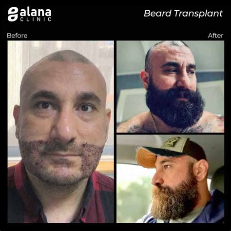 Beard Transplant - Alana Hair Clinic