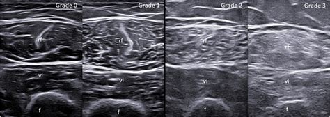 Frontiers | Reliability assessment of ultrasound muscle echogenicity in patients with rheumatic ...