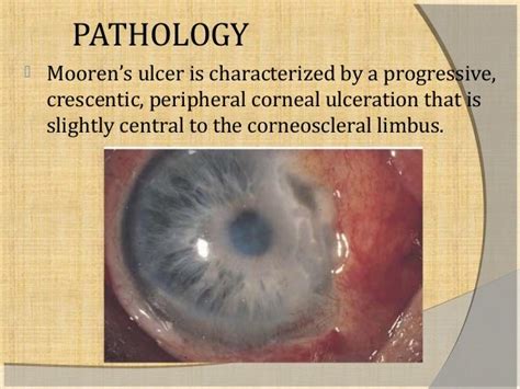 Mooren’s ulcer