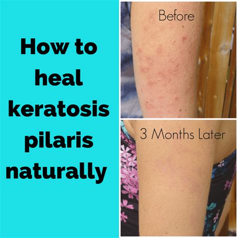 Treatment for Keratosis Pilaris | Dry skin bumps, Keratosis pilaris, Bumpy skin