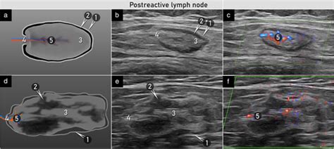 Terms, definitions and measurements to describe sonographic features of ...