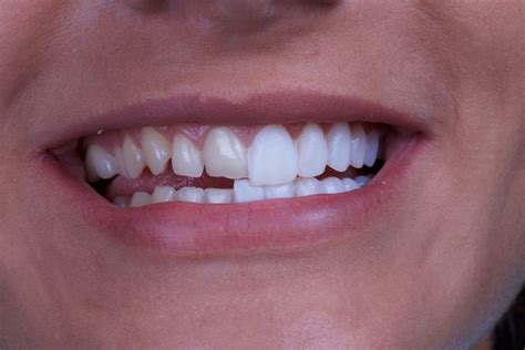 The Difference Between Veneers and Dental Bonding