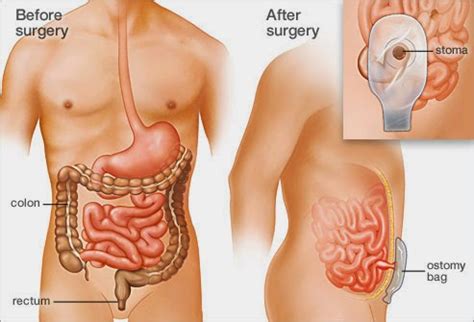 Medical Treatment Pictures-for Better Understanding: Proctocolectomy Surgery: Before & After ...