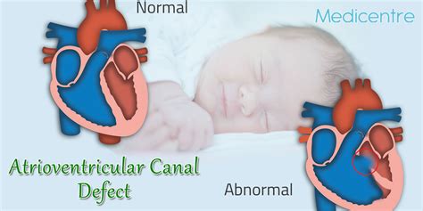 Atrioventricular Canal Defect - Causes, Symptoms & Treatments