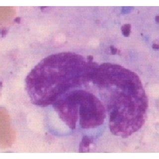 Bone marrow aspirate cytology showing hemophagocytosis in cases of ...