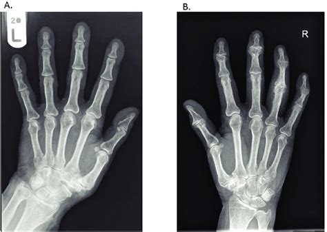 Osteoarthritis Hands X Ray